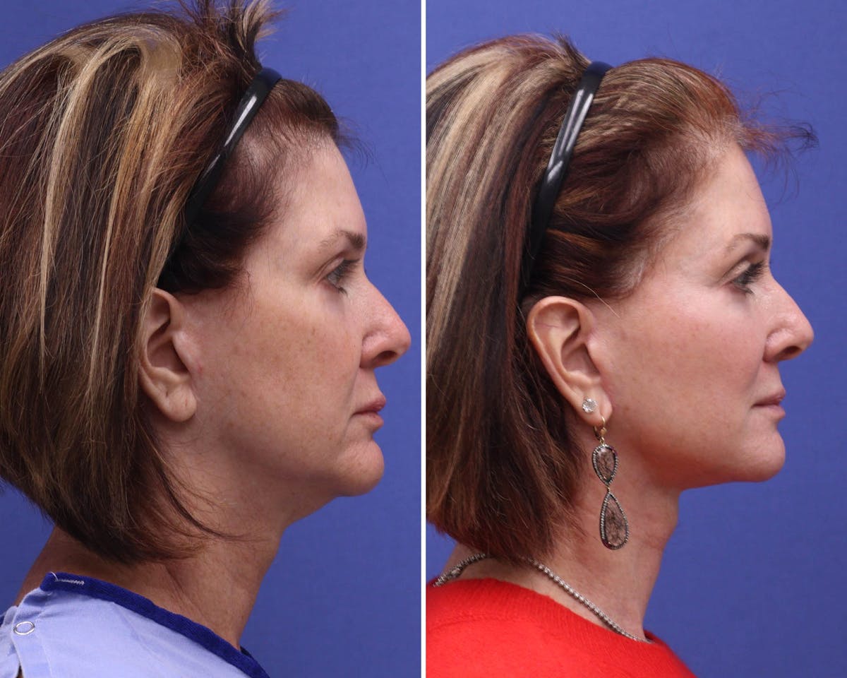 Face Before & After Gallery - Patient 140019 - Image 3