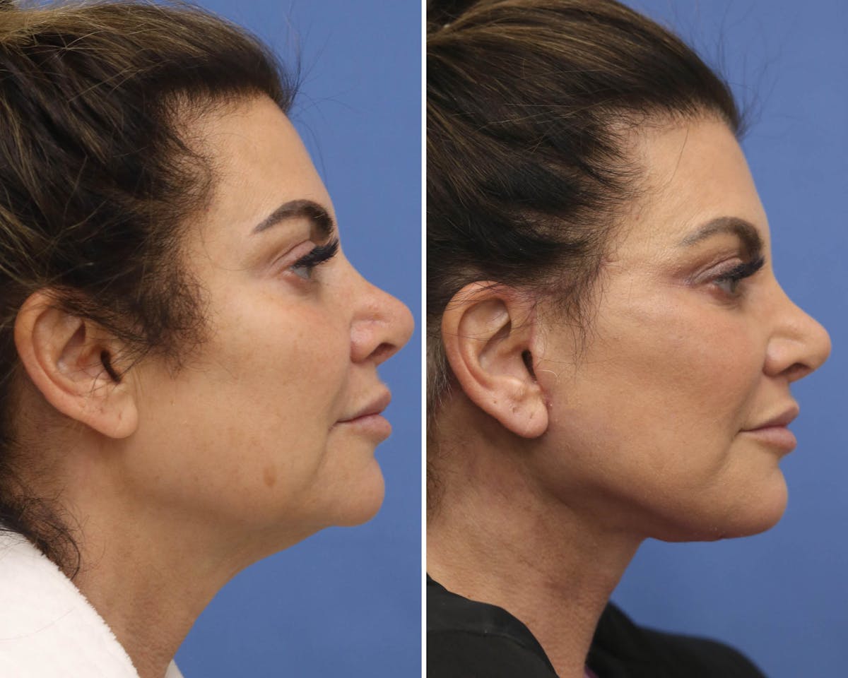 Facelift Before & After Gallery - Patient 416603 - Image 3