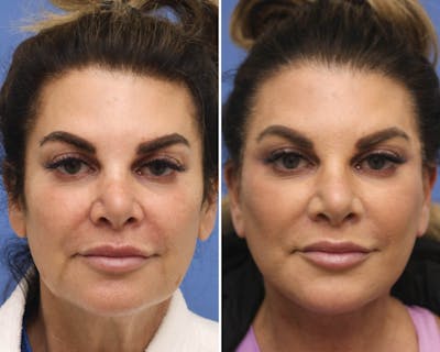 Face Before & After Gallery - Patient 267359 - Image 1