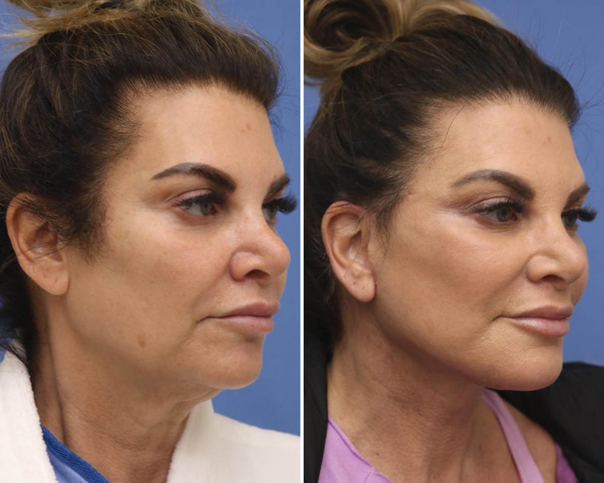Facelift Before & After Gallery - Patient 416603 - Image 2
