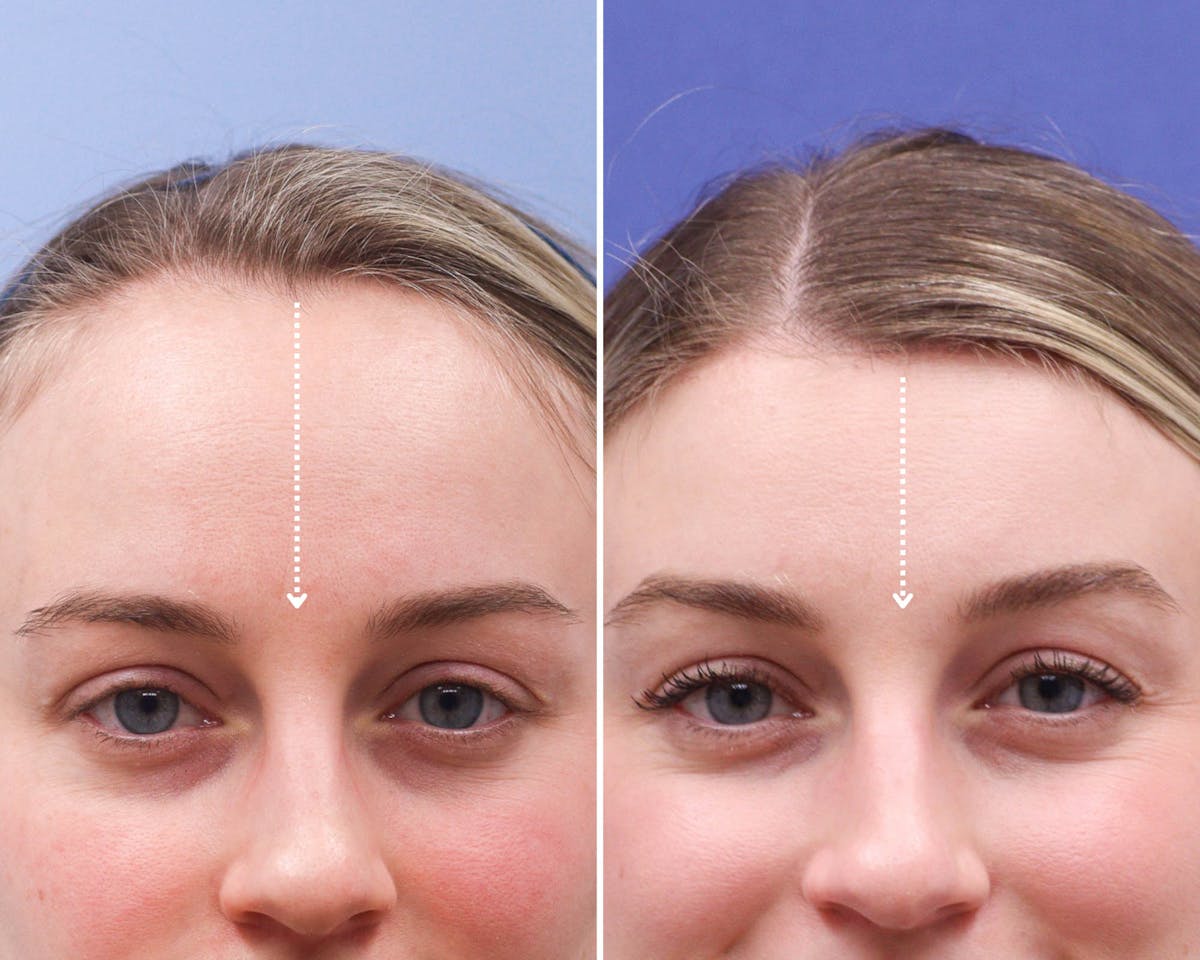 Forehead Reduction Before & After Gallery - Patient 165585 - Image 5