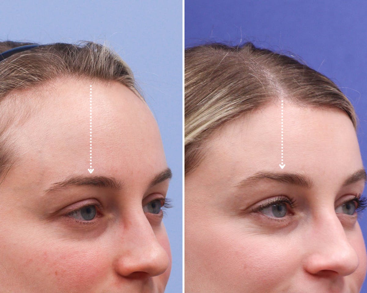Forehead Reduction Before & After Gallery - Patient 165585 - Image 4