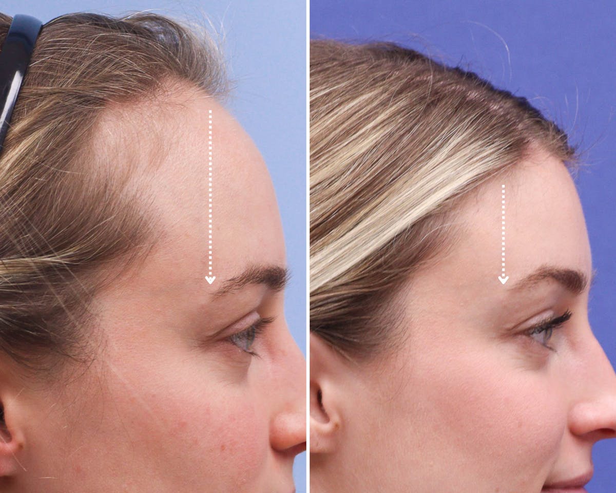 Forehead Reduction Before & After Gallery - Patient 165585 - Image 6