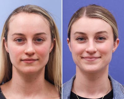 Face Before & After Gallery - Patient 614327 - Image 1