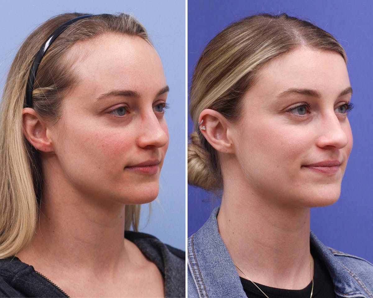 Forehead Reduction Before & After Gallery - Patient 165585 - Image 2