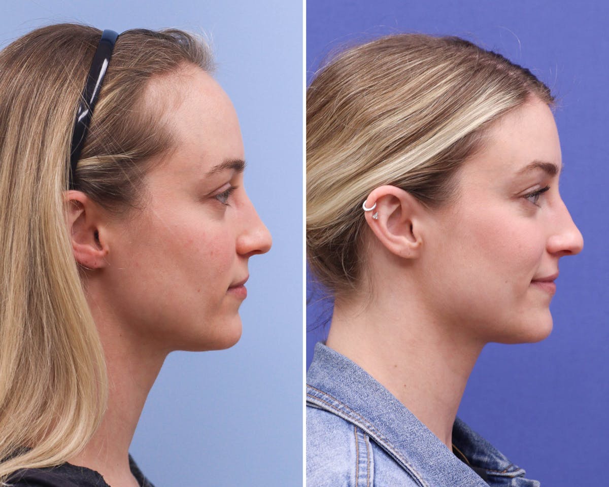 Forehead Reduction Before & After Gallery - Patient 165585 - Image 3