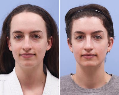 Face Before & After Gallery - Patient 257812 - Image 1
