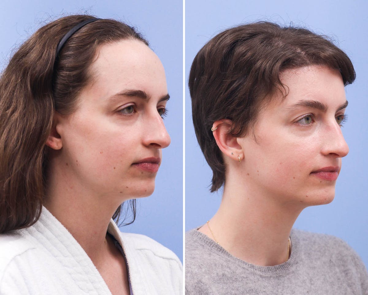 Forehead Reduction Before & After Gallery - Patient 327816 - Image 2