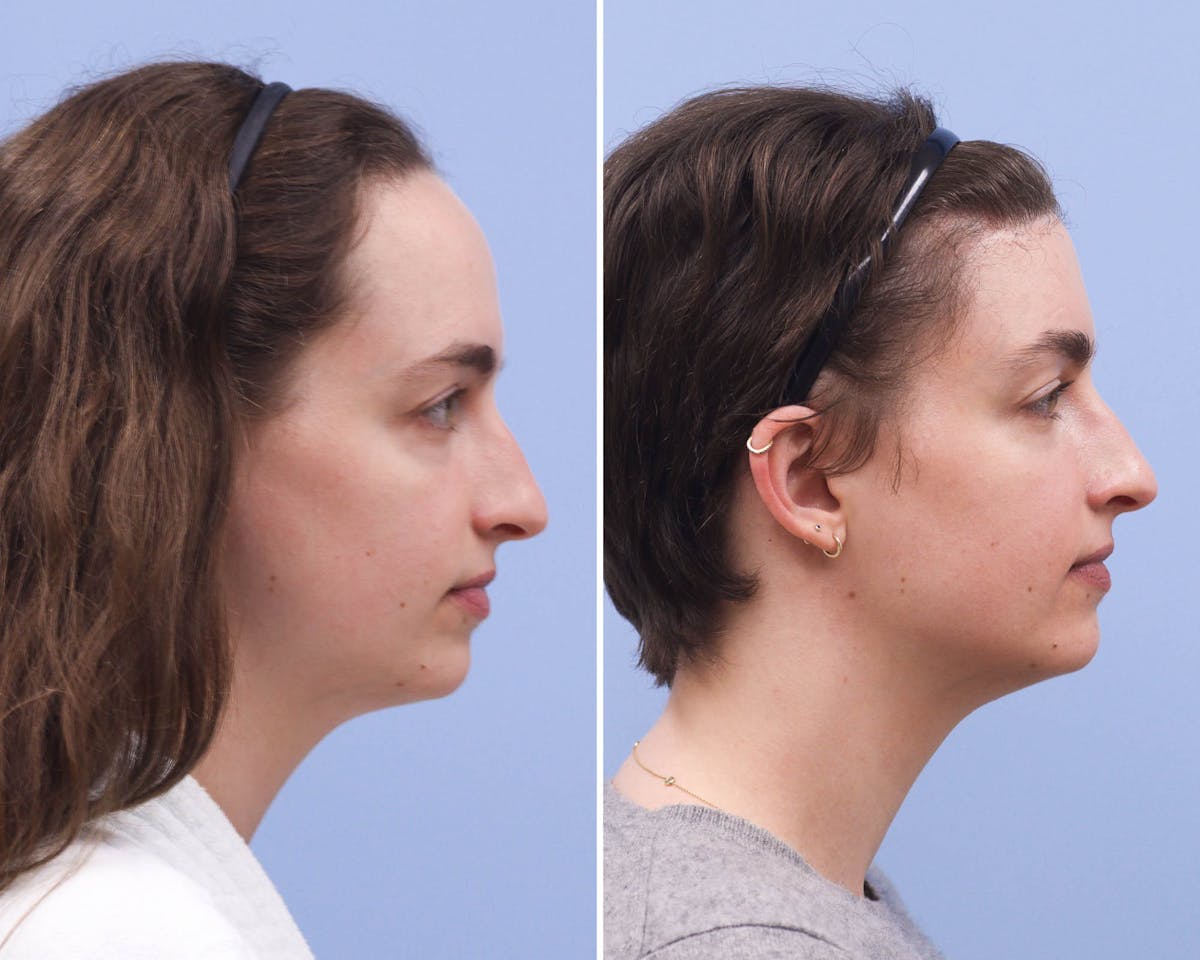 Forehead Reduction Before & After Gallery - Patient 327816 - Image 3