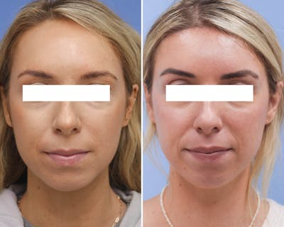 Brow Lift Before & After Gallery - Patient 421568 - Image 1