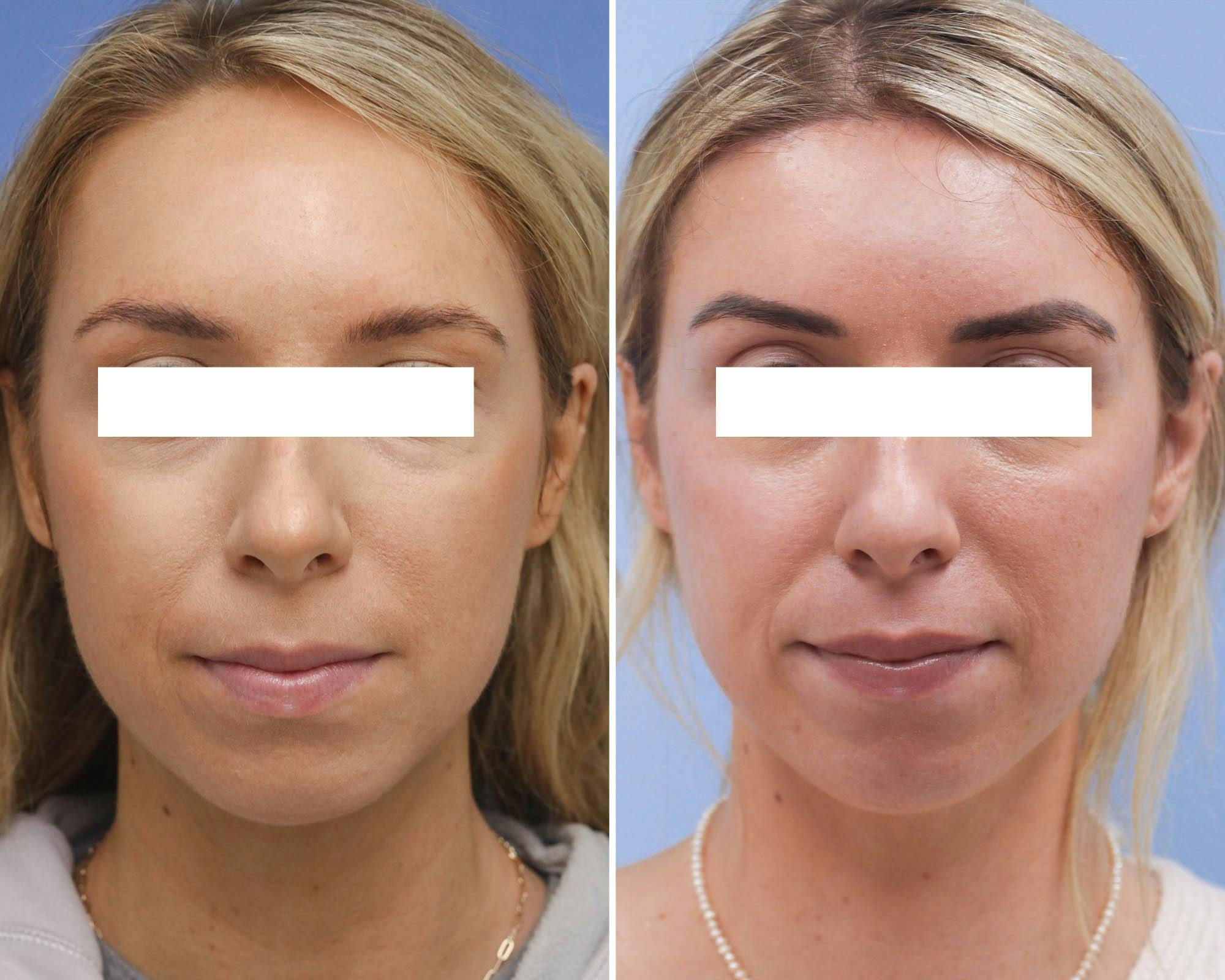 Brow Lift Before & After Gallery - Patient 421568 - Image 1