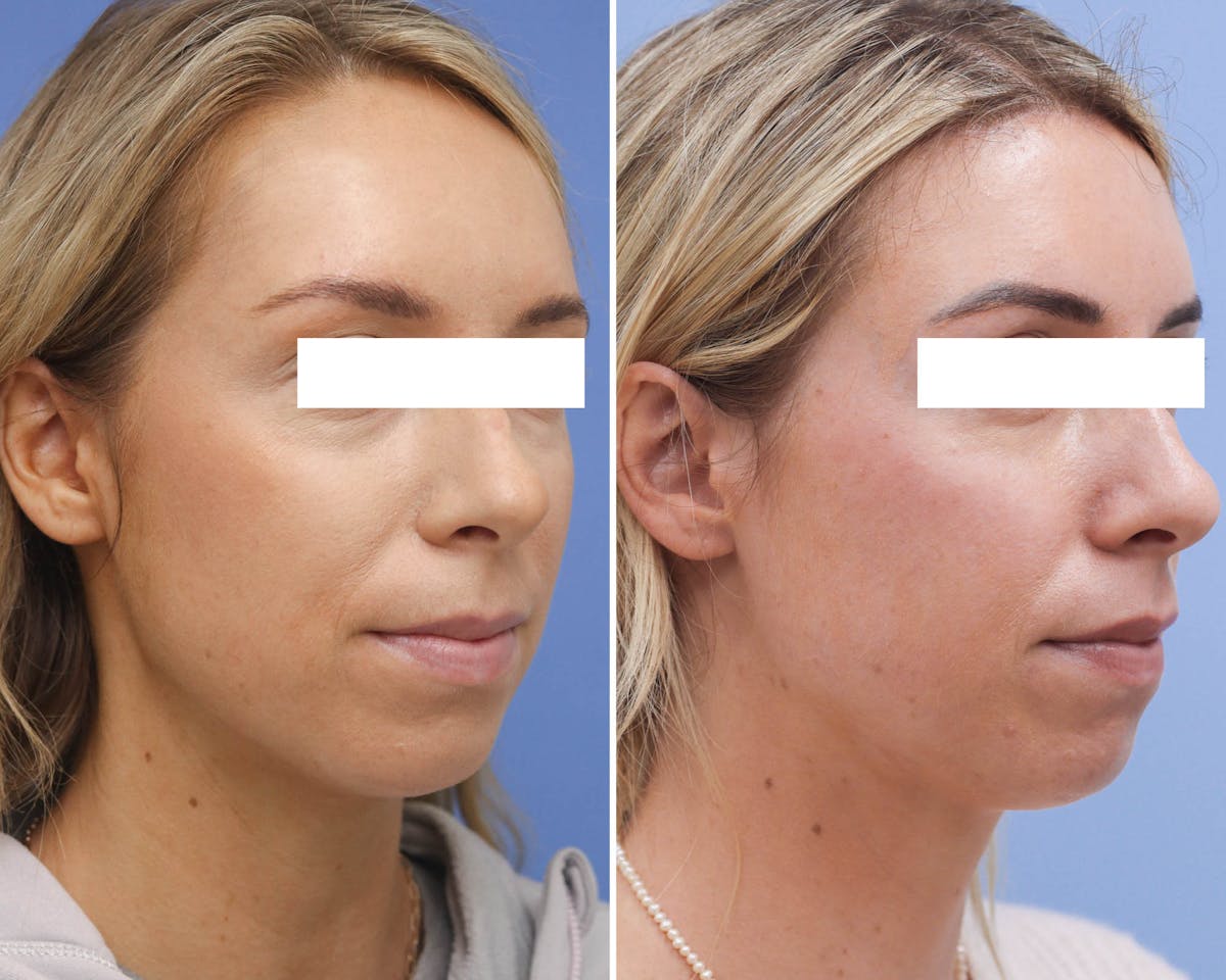 Face Before & After Gallery - Patient 174641 - Image 1