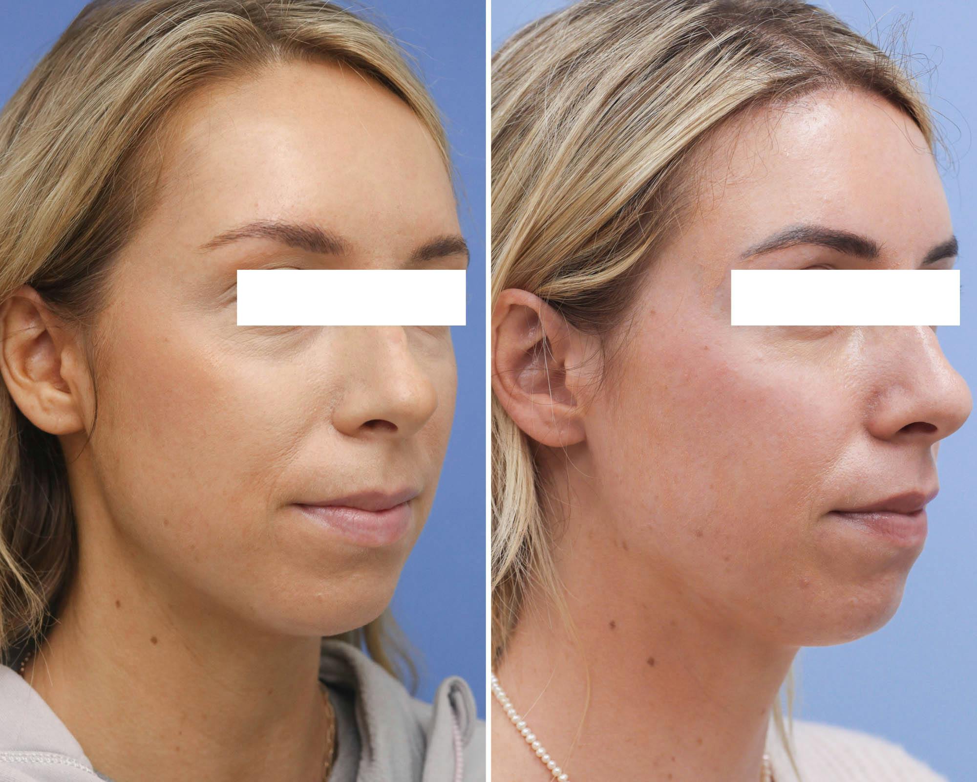 Brow Lift Before & After Gallery - Patient 421568 - Image 2
