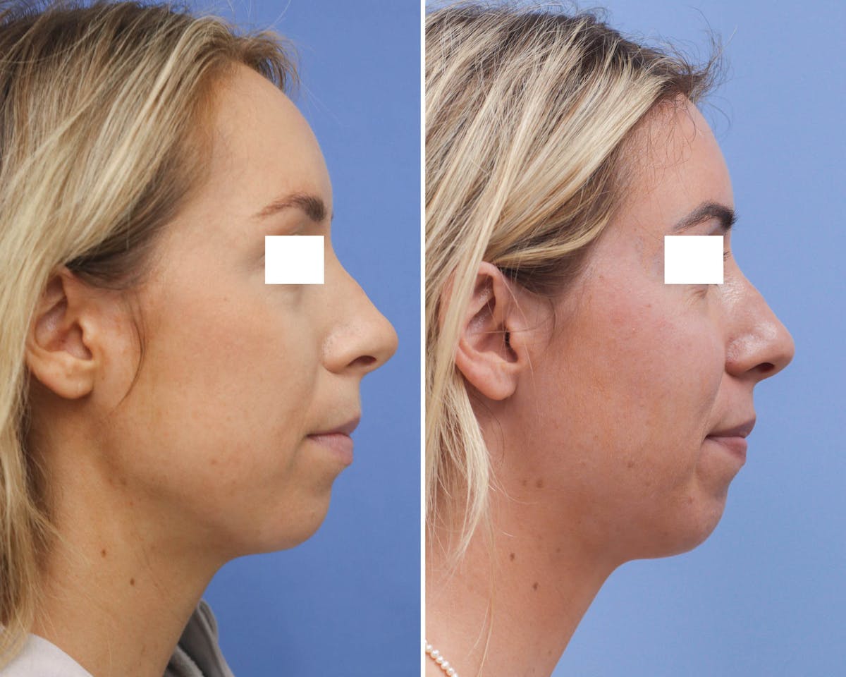 Face Before & After Gallery - Patient 174641 - Image 3