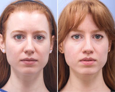 Lips Before & After Gallery - Patient 230220 - Image 1
