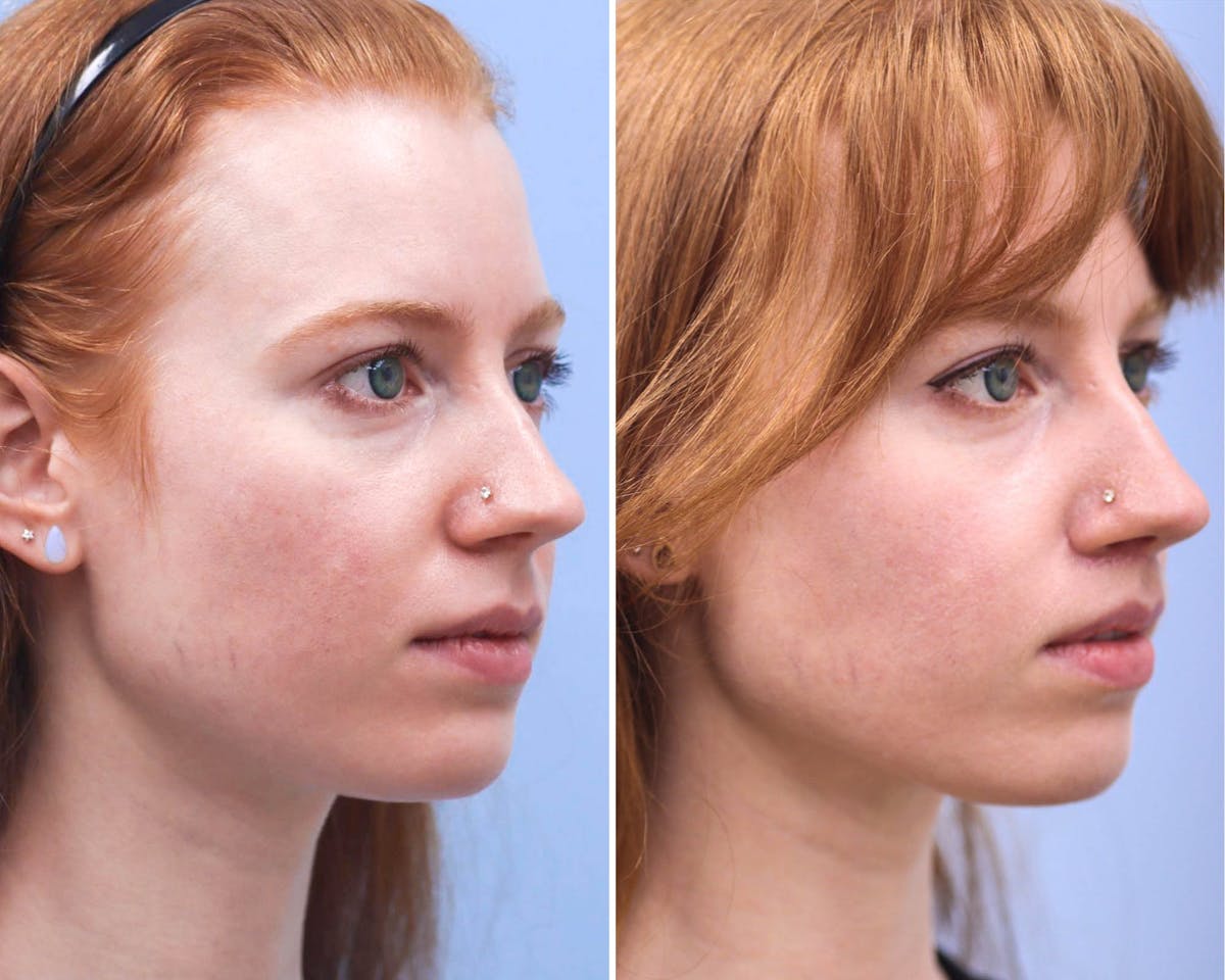 Lips Before & After Gallery - Patient 230220 - Image 2