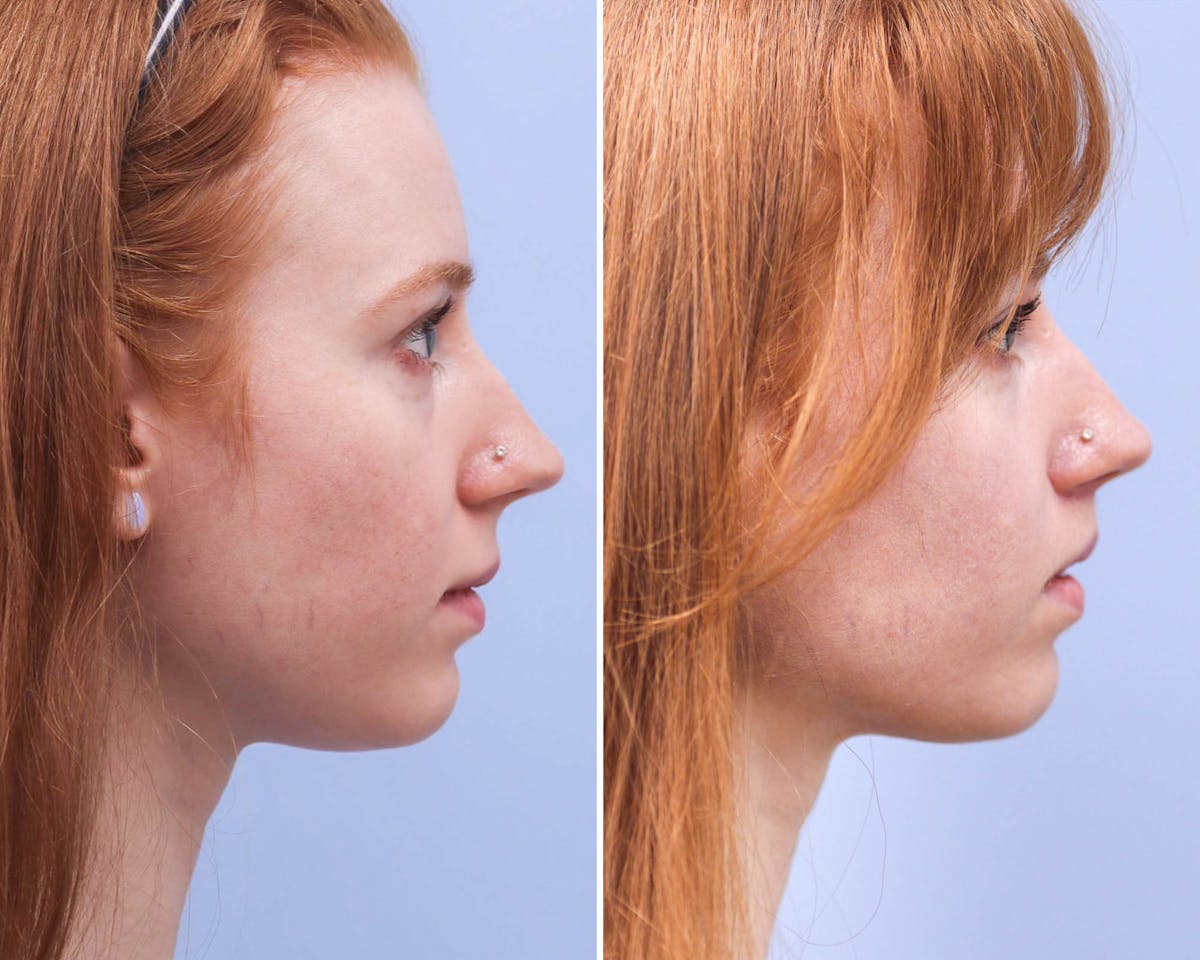 Lips Before & After Gallery - Patient 230220 - Image 3