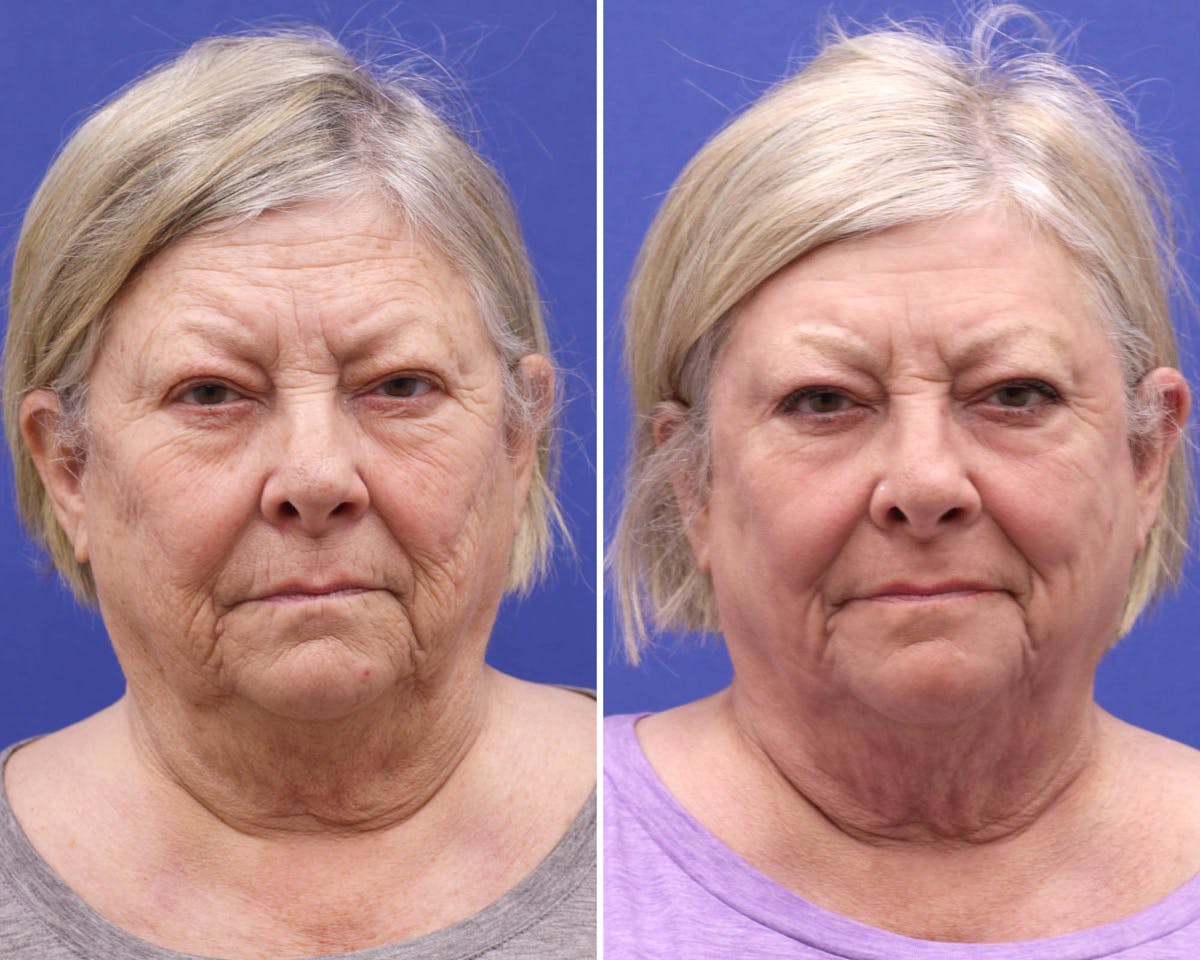 Face Before & After Gallery - Patient 196925 - Image 1