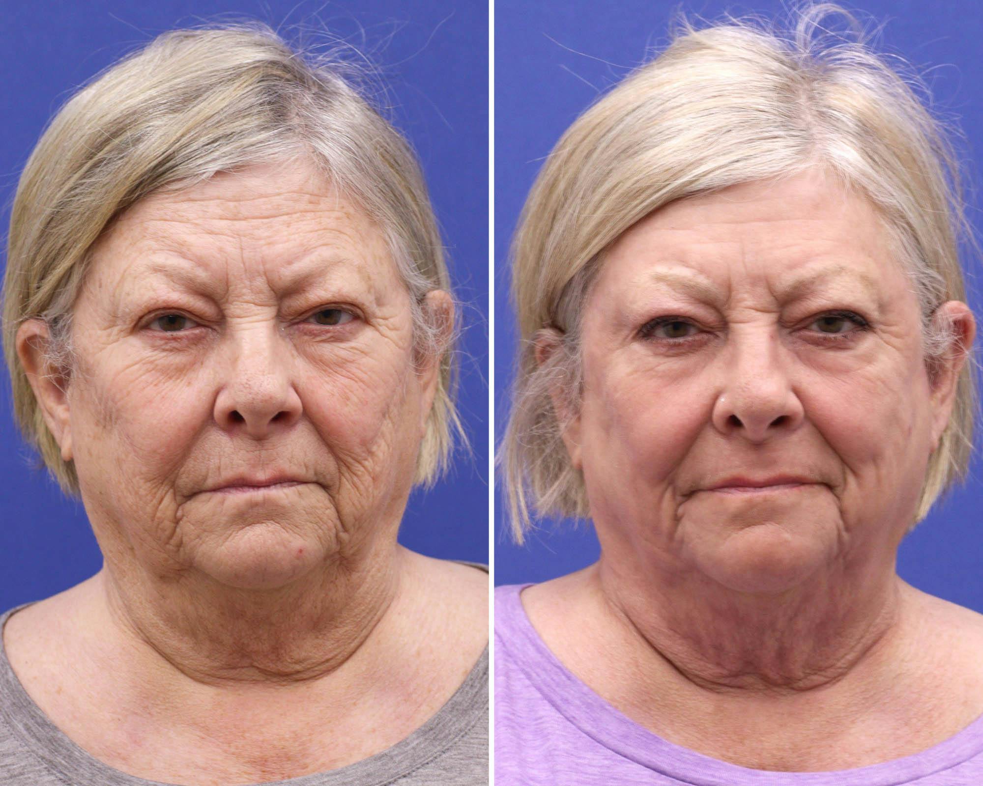 CO2 Laser Resurfacing Before & After Gallery - Patient 351937 - Image 1