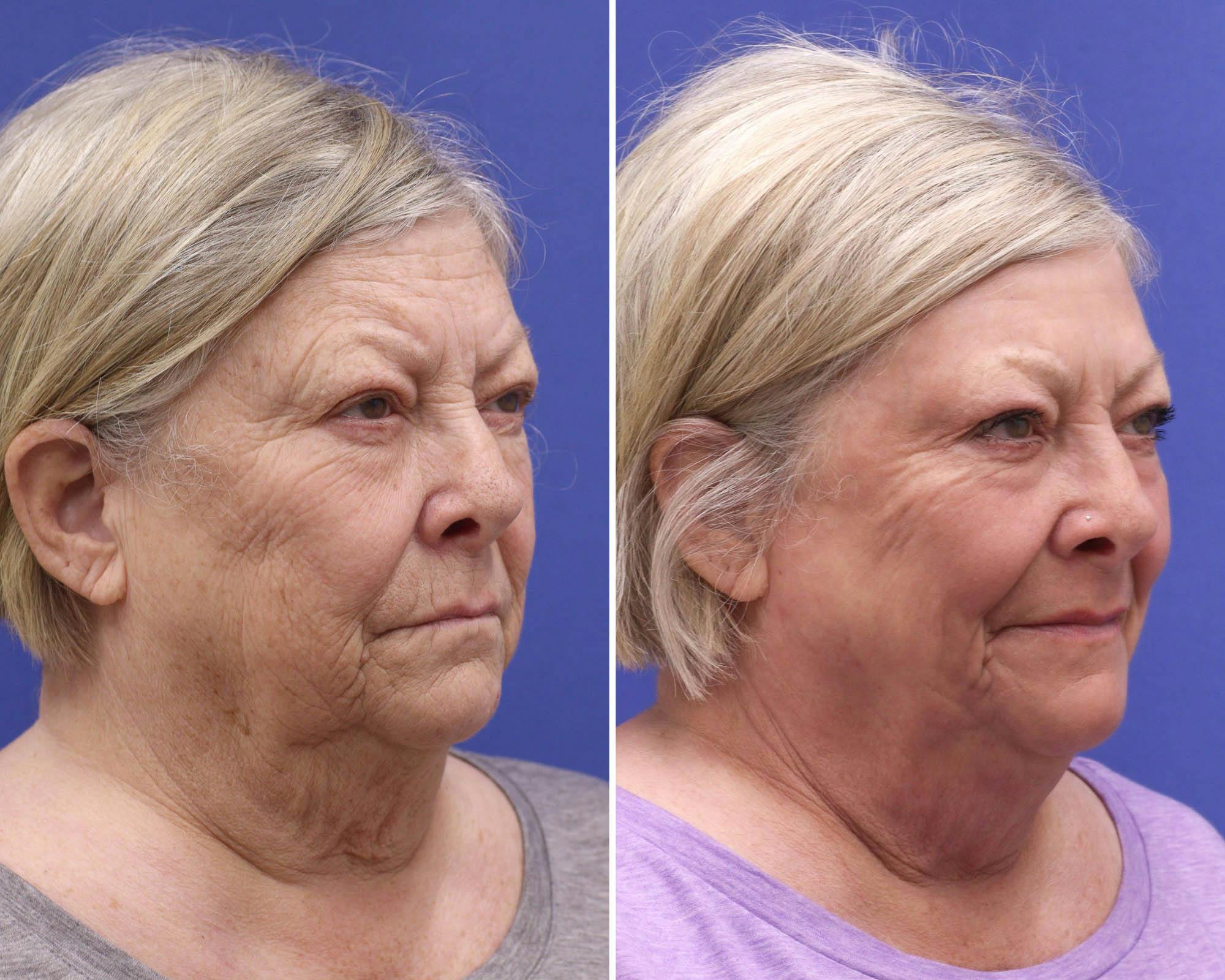 CO2 Laser Resurfacing Before & After Gallery - Patient 351937 - Image 2
