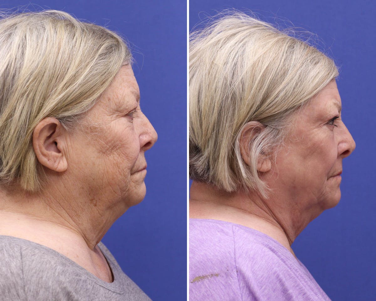 Face Before & After Gallery - Patient 196925 - Image 3