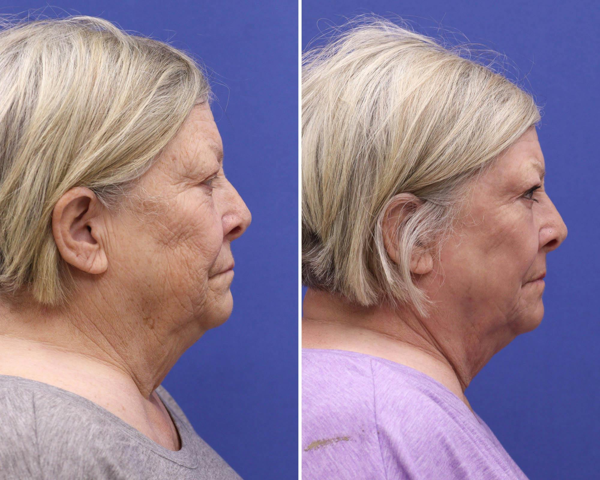 CO2 Laser Resurfacing Before & After Gallery - Patient 351937 - Image 3