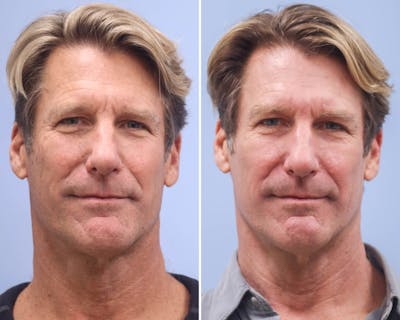 CO2 Laser Resurfacing Before & After Gallery - Patient 345901 - Image 1