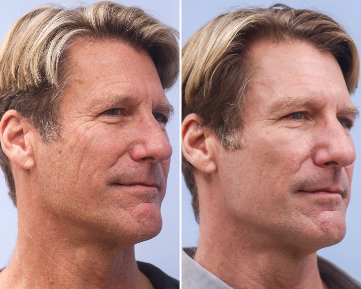 CO2 Laser Resurfacing Before & After Gallery - Patient 345901 - Image 2
