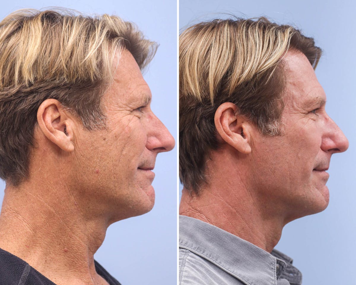 CO2 Laser Resurfacing Before & After Gallery - Patient 345901 - Image 3