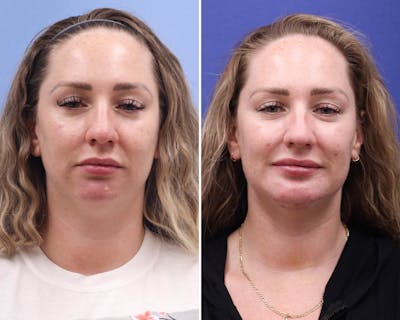 Neck Before & After Gallery - Patient 300610 - Image 1