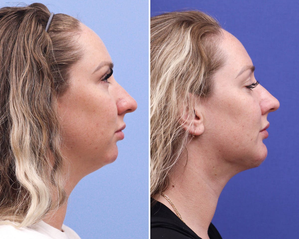 Neck Before & After Gallery - Patient 300610 - Image 3