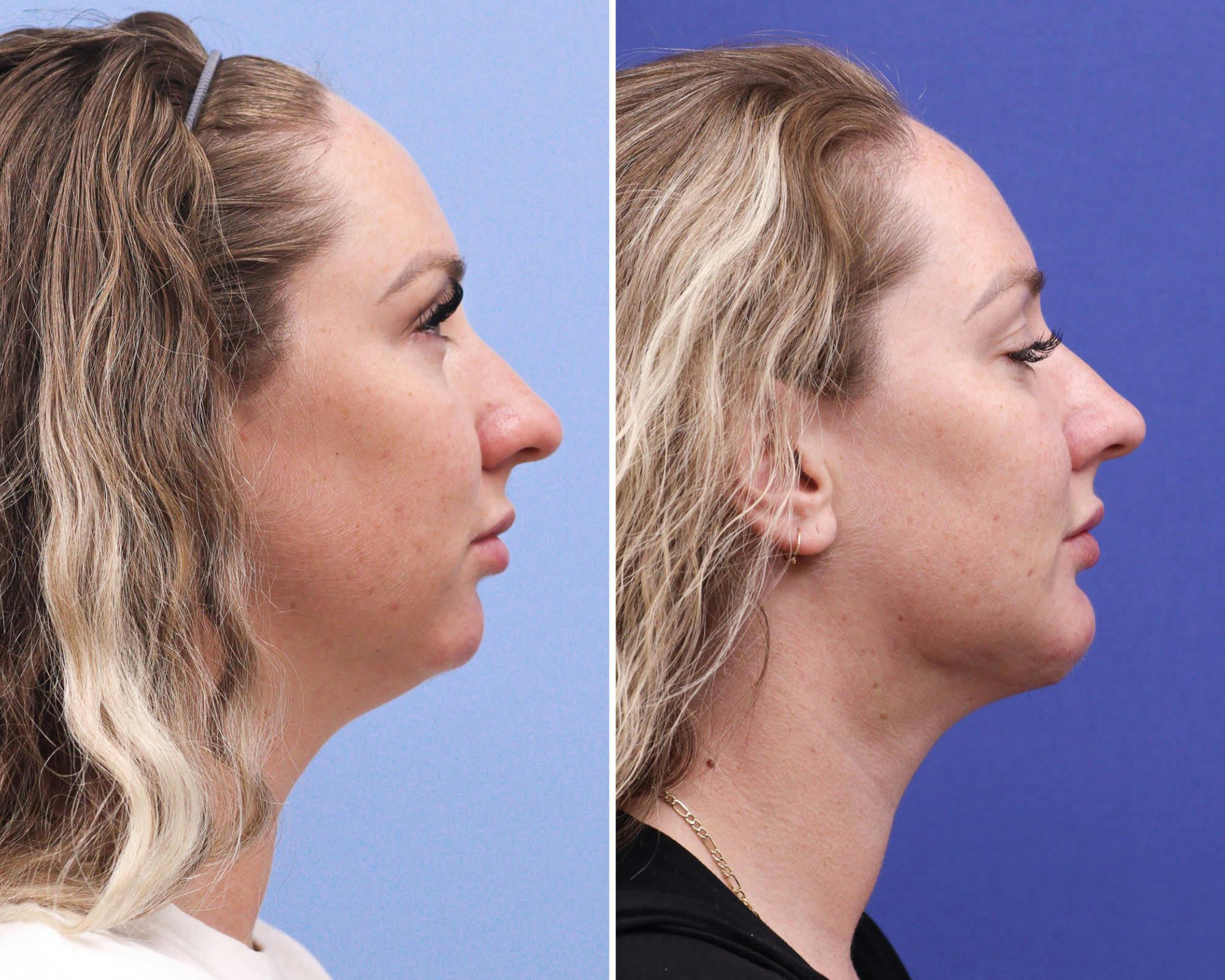 Submental Liposuction Before & After Gallery - Patient 208042 - Image 3