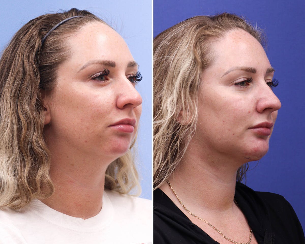 Neck Before & After Gallery - Patient 300610 - Image 2