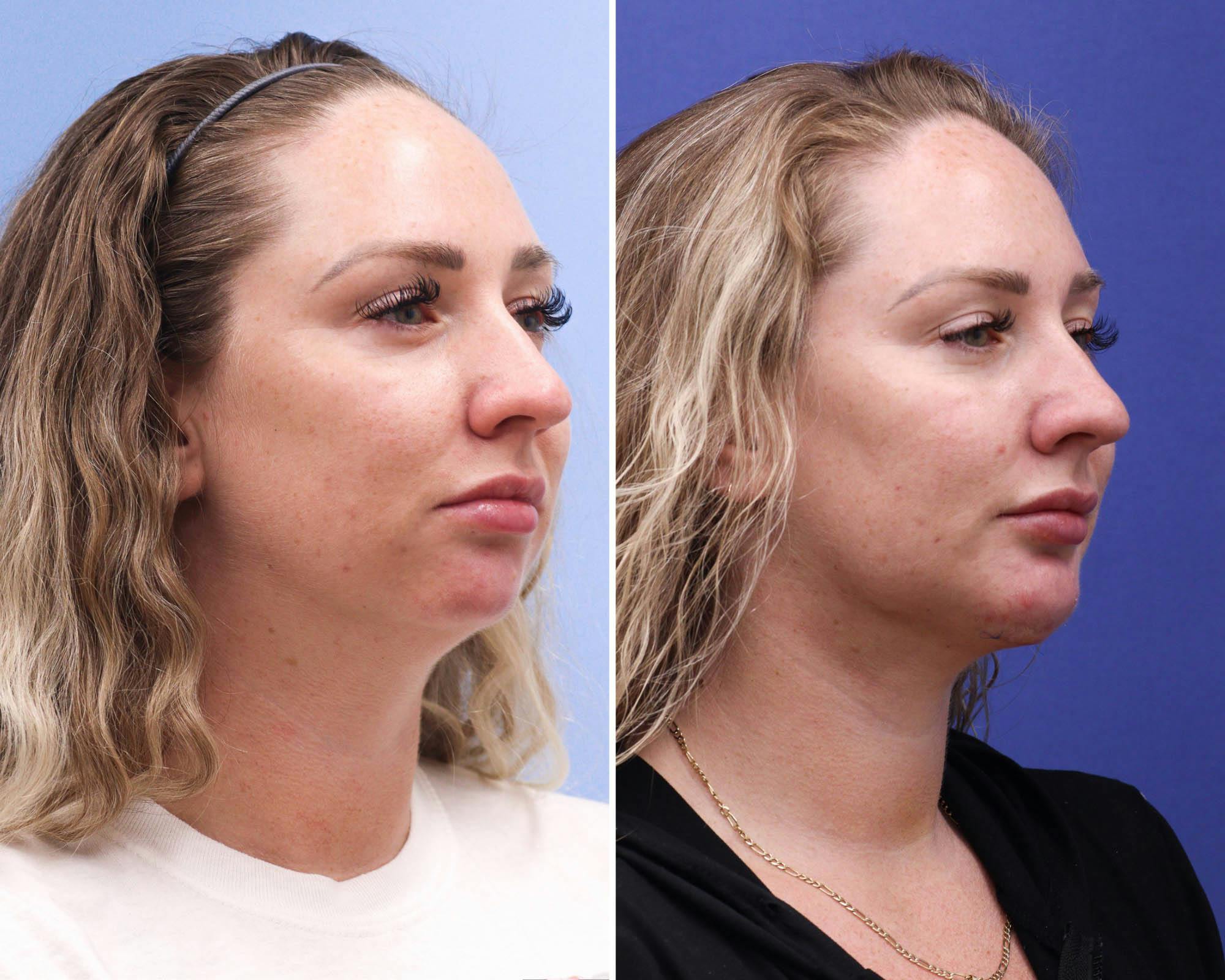 Submental Liposuction Before & After Gallery - Patient 208042 - Image 2