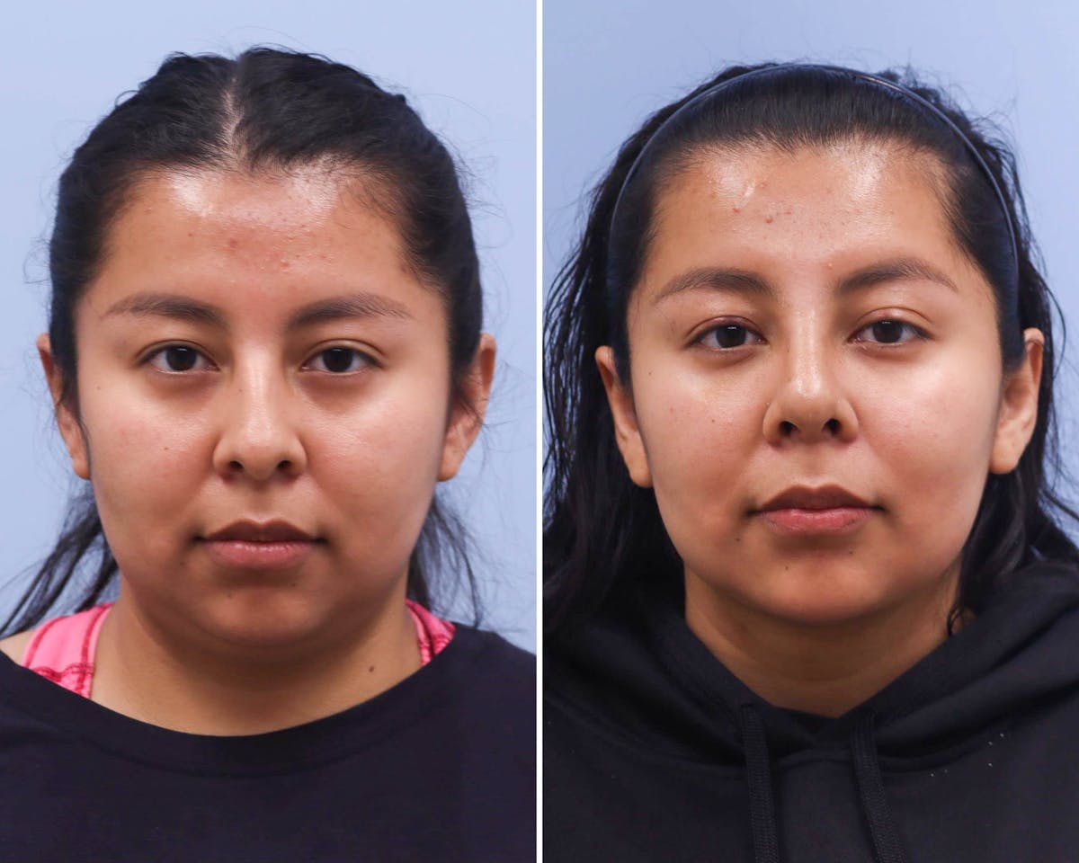 Neck Before & After Gallery - Patient 429023 - Image 2