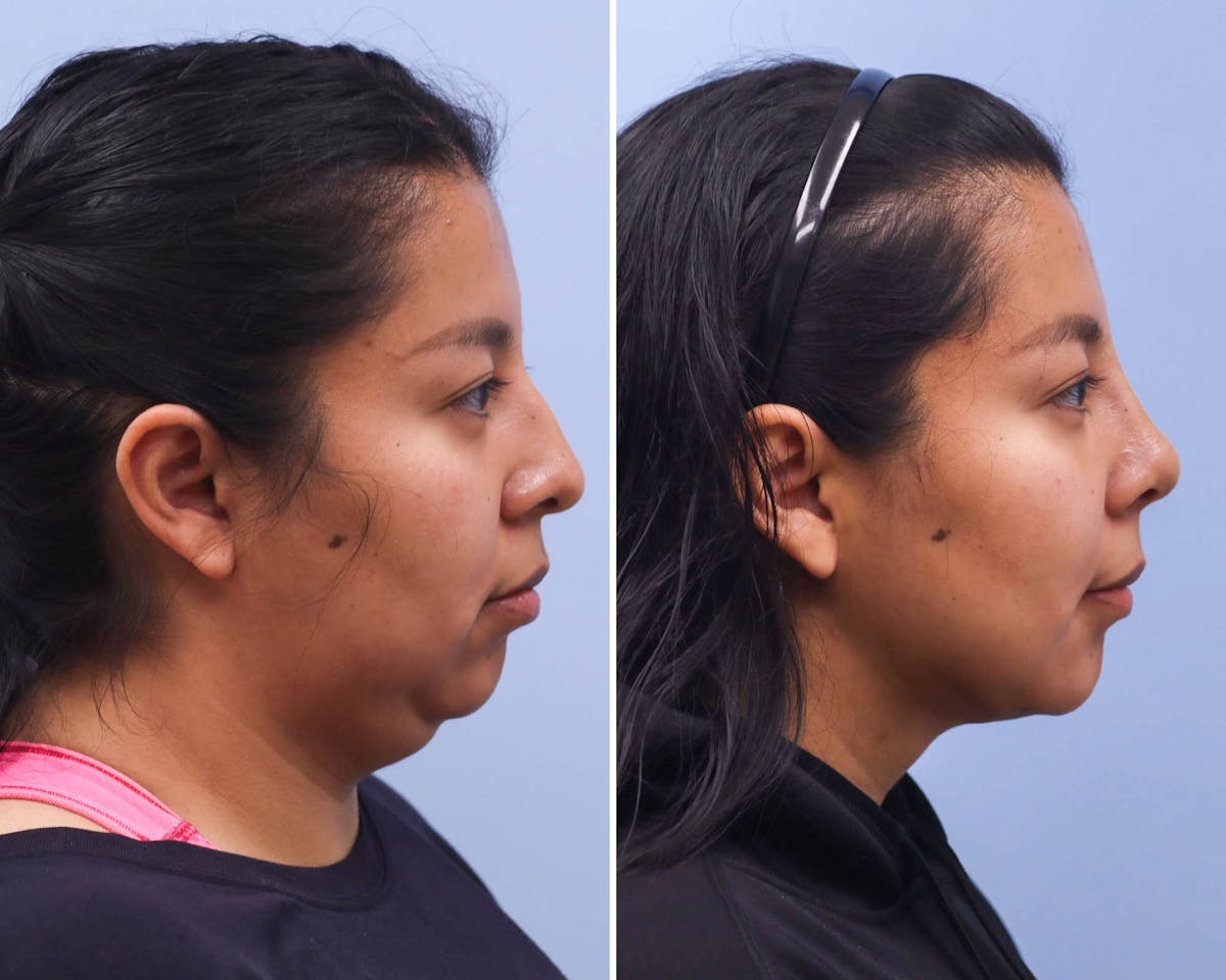 Neck Before & After Gallery - Patient 429023 - Image 3