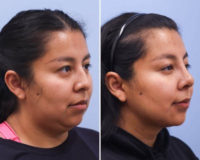 Neck Before & After Gallery - Patient 429023 - Image 1