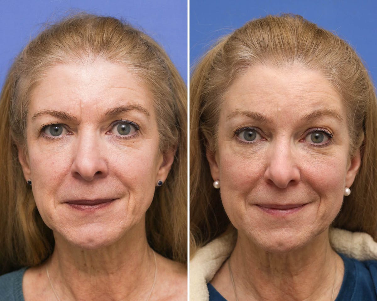 Temple Lift Before & After Gallery - Patient 300778 - Image 1