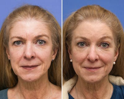 Temple Lift Before & After Gallery - Patient 300778 - Image 1