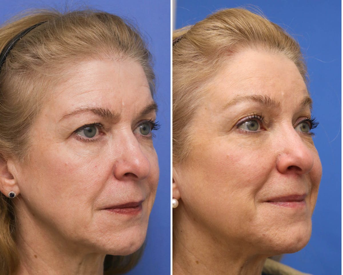Temple Lift Before & After Gallery - Patient 300778 - Image 3