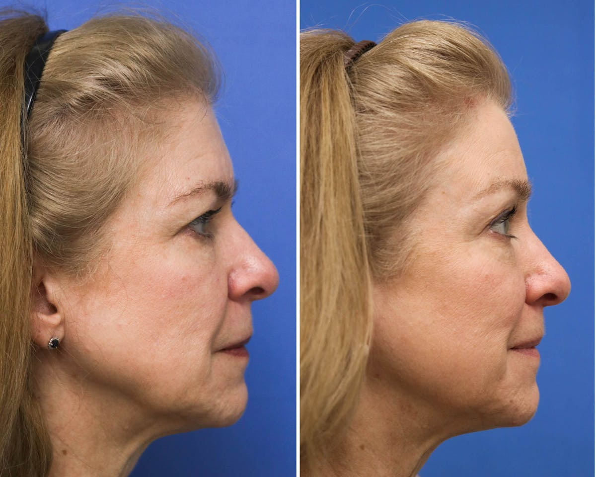 Temple Lift Before & After Gallery - Patient 300778 - Image 2