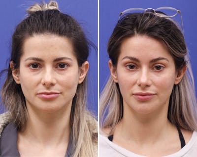 Temple Lift Before & After Gallery - Patient 211841 - Image 1