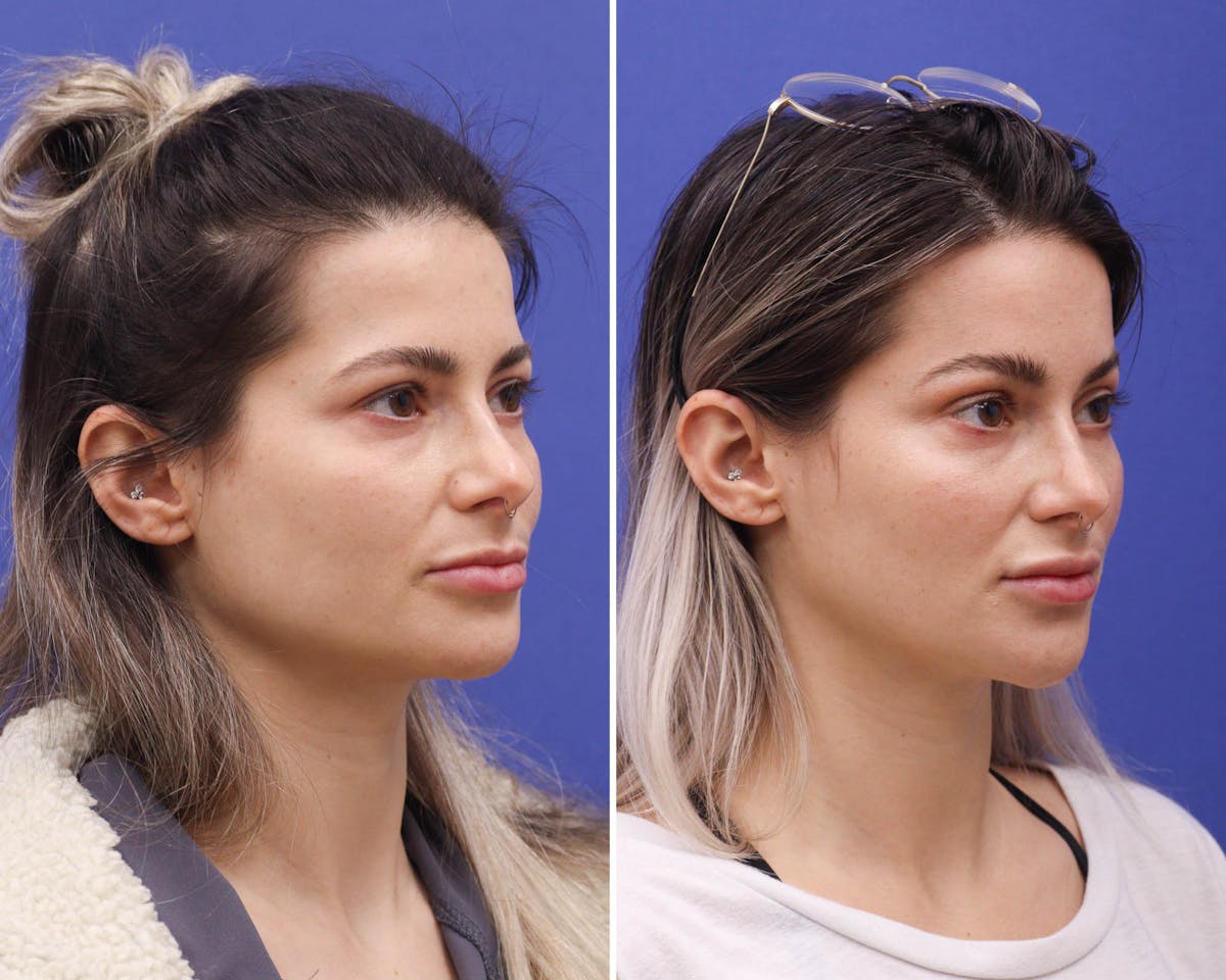 Temple Lift Before & After Gallery - Patient 211841 - Image 3