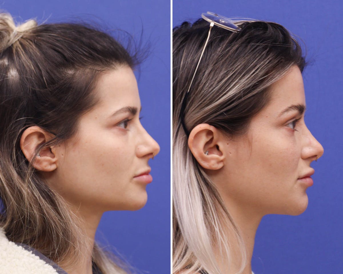 Temple Lift Before & After Gallery - Patient 211841 - Image 2
