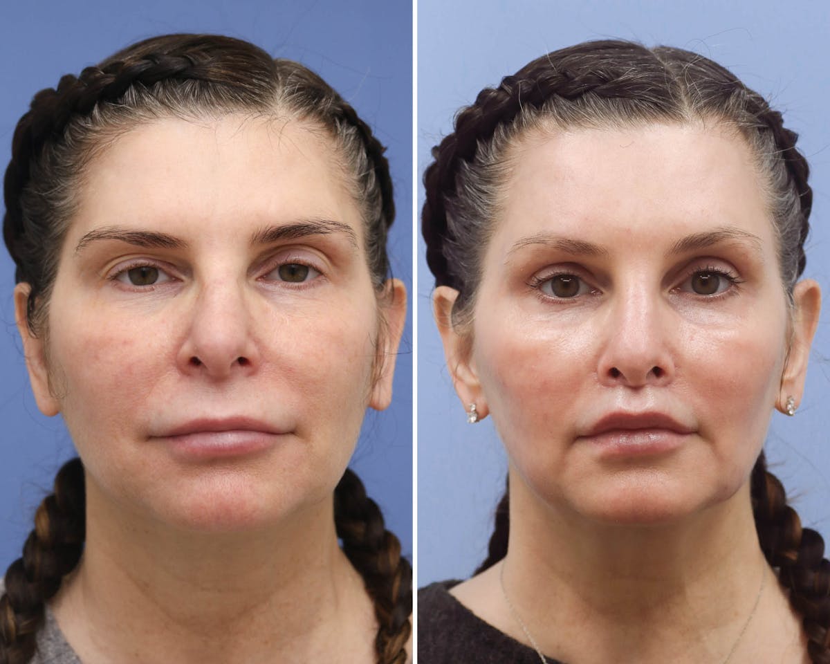 Temple Lift Before & After Gallery - Patient 121954 - Image 1