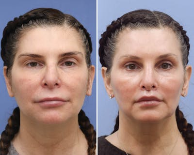 Temple Lift Before & After Gallery - Patient 121954 - Image 1
