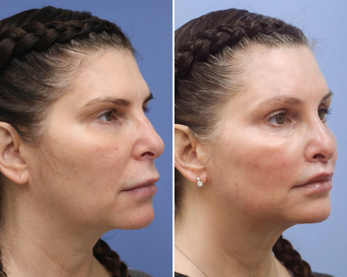 Temple Lift Before & After Gallery - Patient 121954 - Image 3