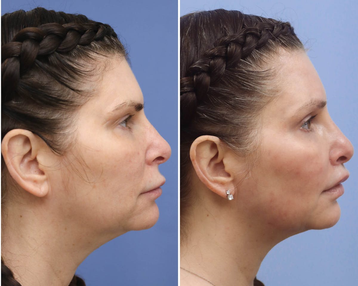 Temple Lift Before & After Gallery - Patient 121954 - Image 2