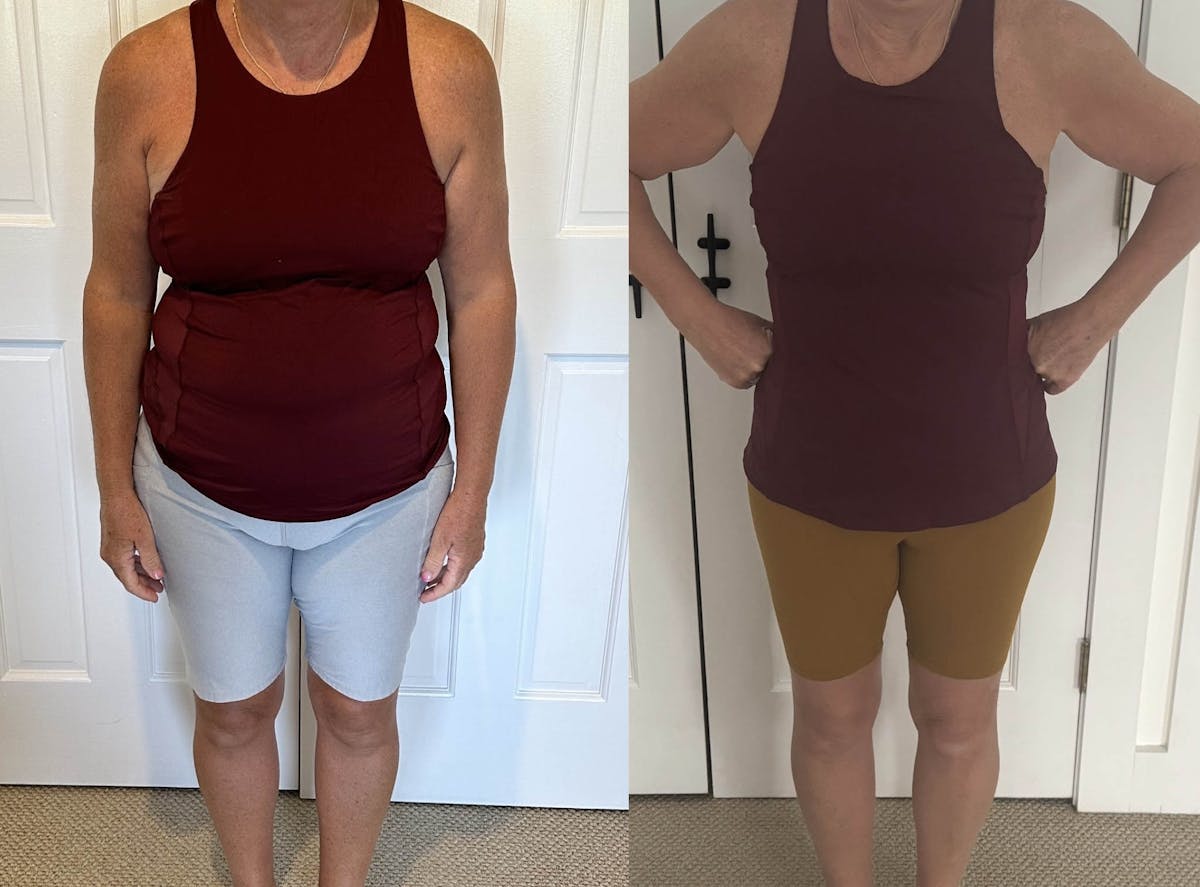 Weight Loss Before & After Gallery - Patient 414849 - Image 1