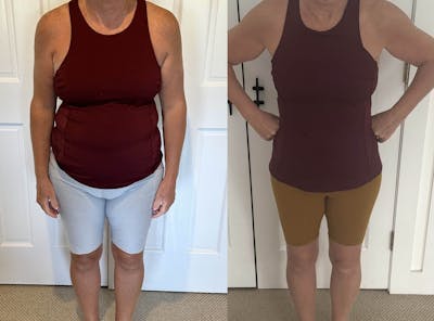 Weight Loss Before & After Gallery - Patient 414849 - Image 1